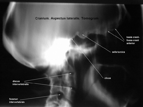 anatomia radiologiczna - aspectus lateralis tomogram.jpg